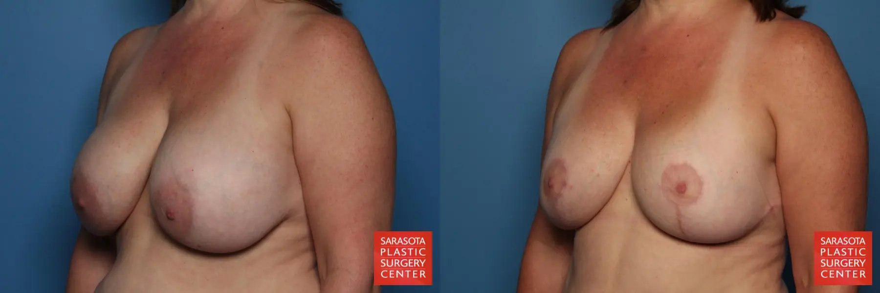 Breast Revision: Patient 11 - Before and After 2