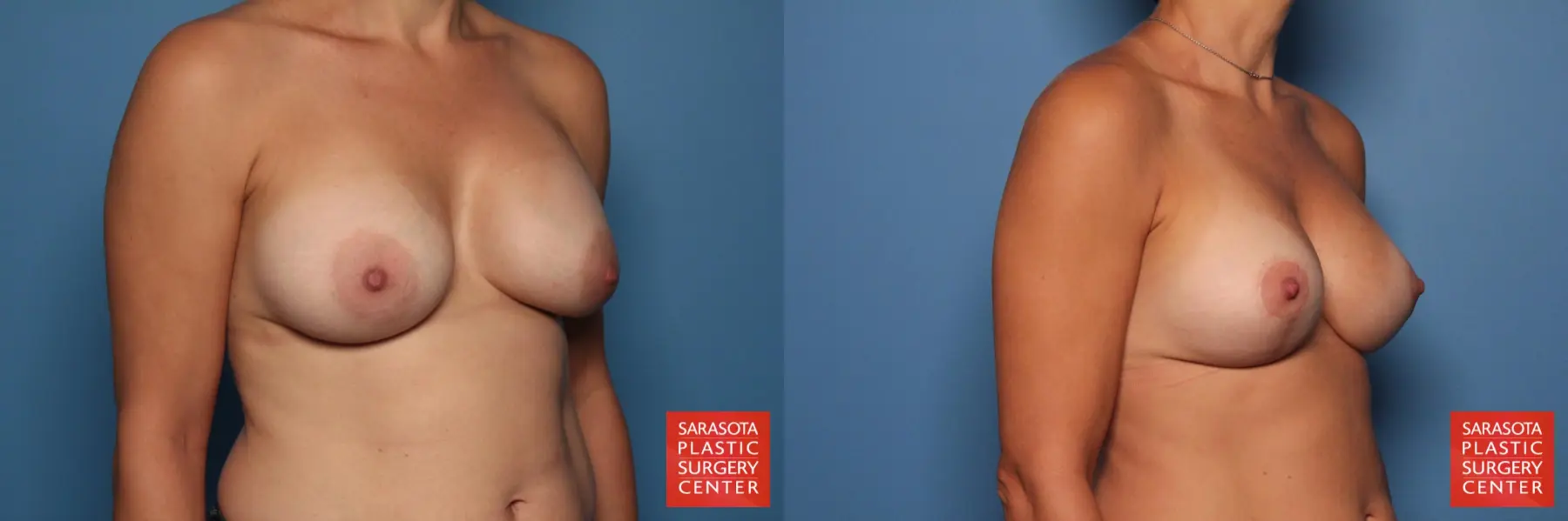 Breast Revision: Patient 10 - Before and After 4