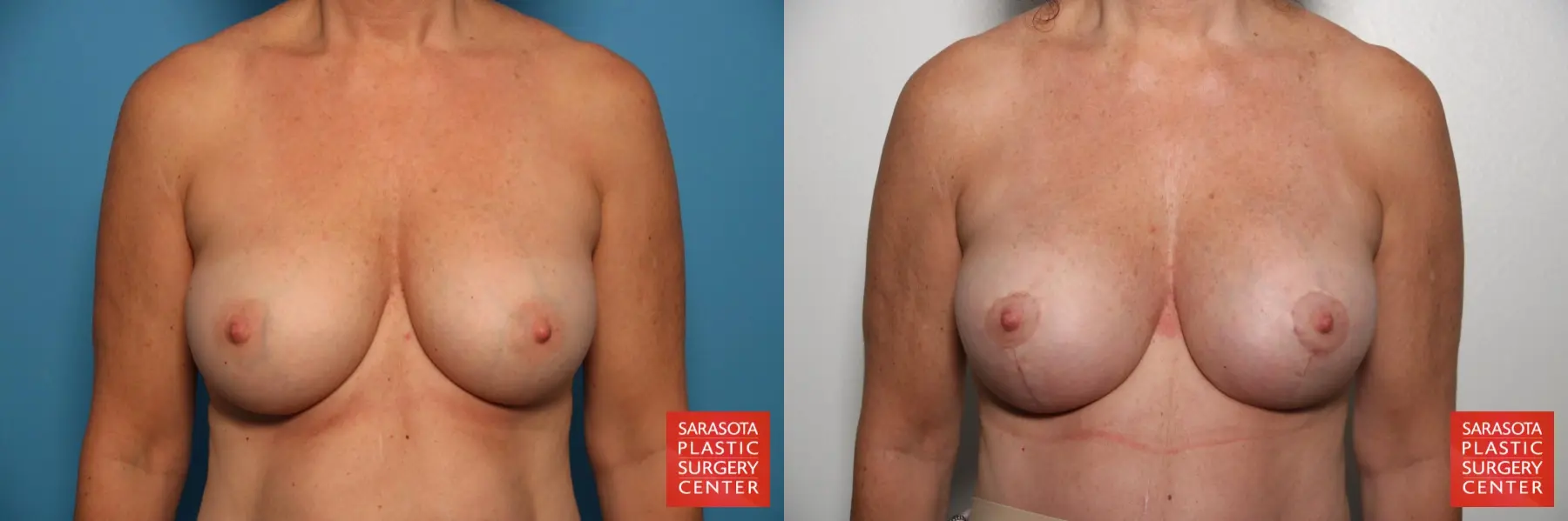 Breast Revision: Patient 4 - Before and After  