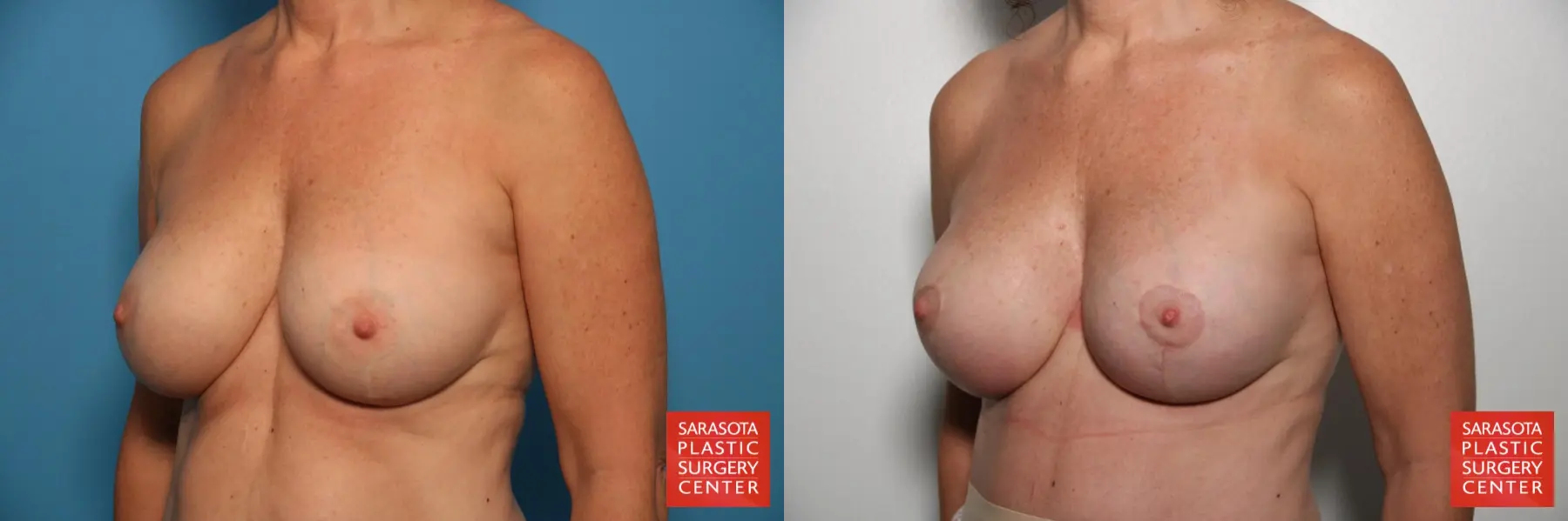 Breast Revision: Patient 4 - Before and After 2