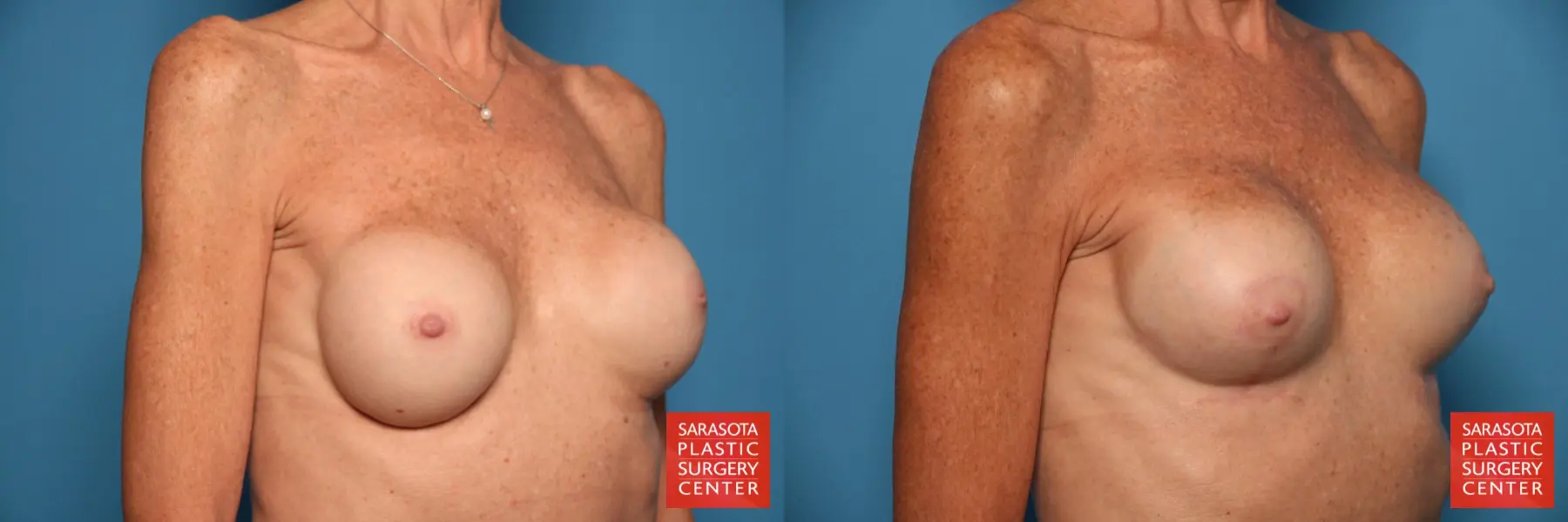 Breast Revision: Patient 6 - Before and After 4