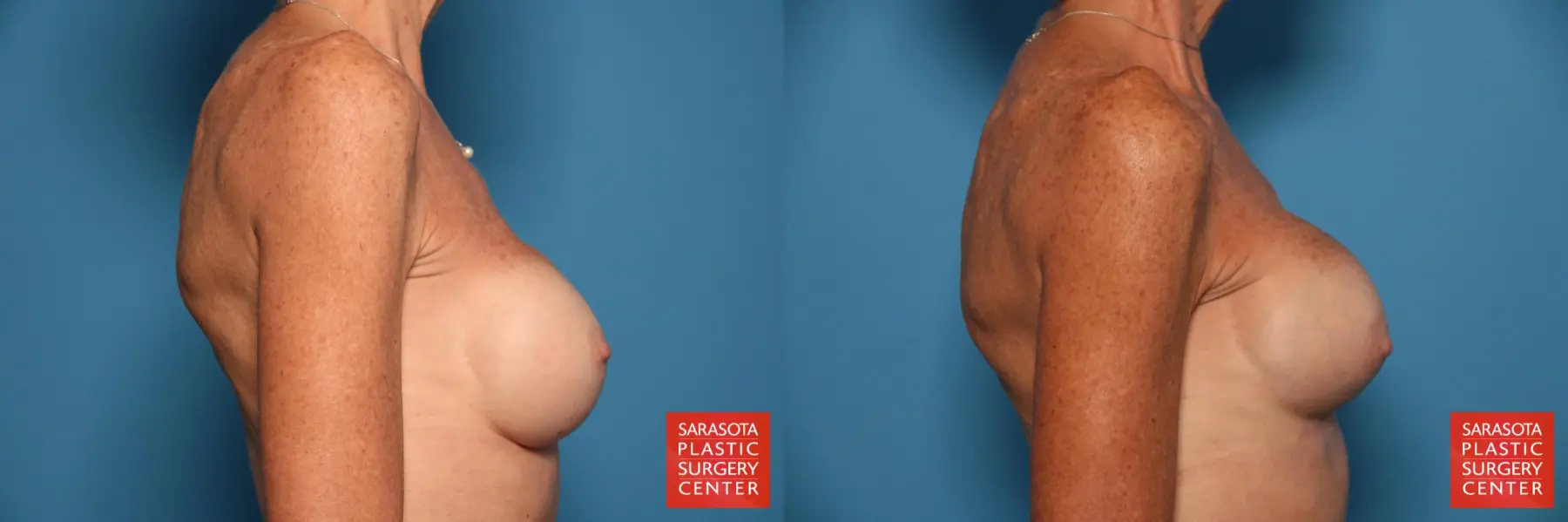 Breast Revision: Patient 7 - Before and After 5