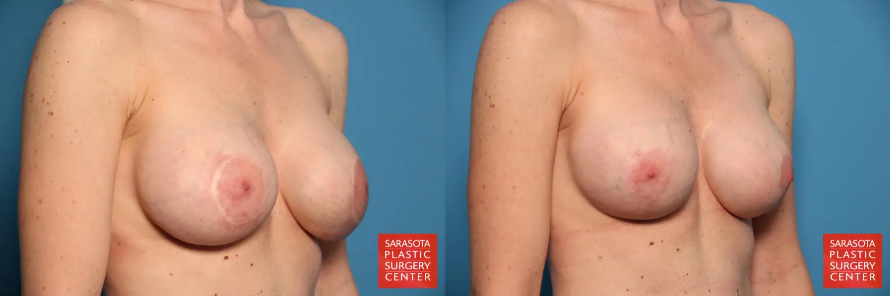 Breast Revision: Patient 5 - Before and After 2