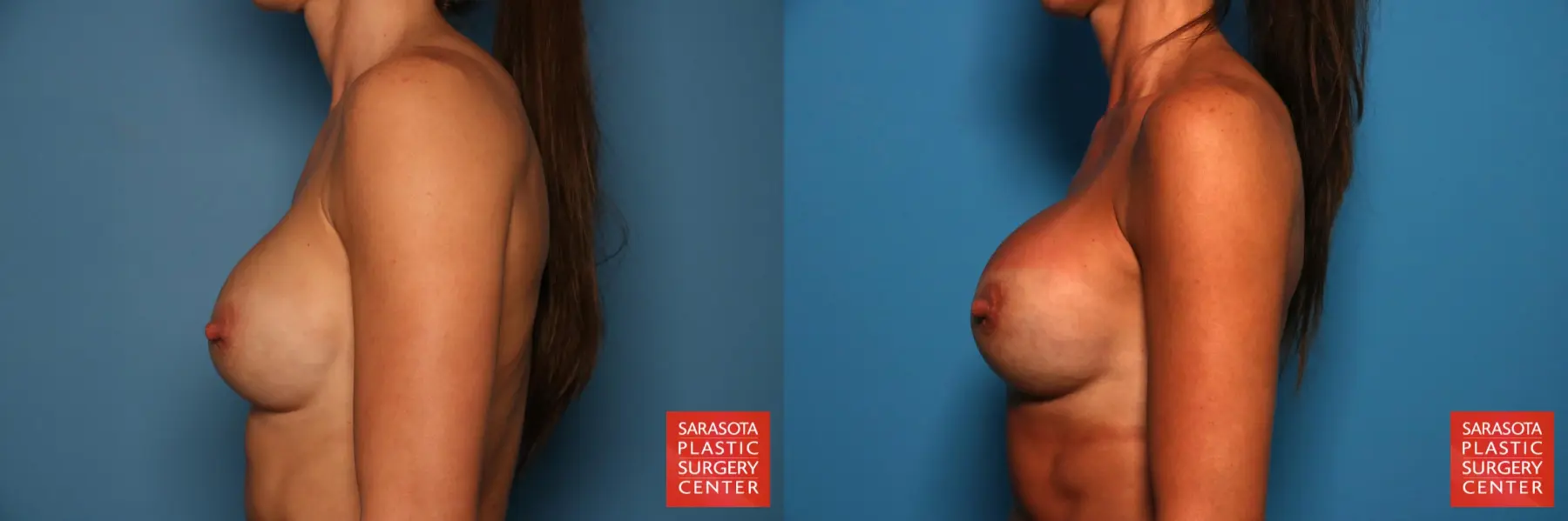 Breast Revision: Patient 8 - Before and After 3