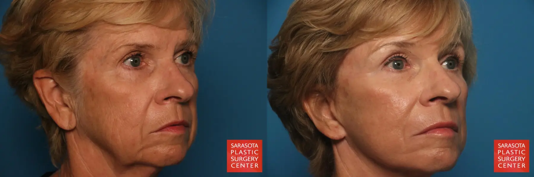 Brow Lift: Patient 5 - Before and After 3