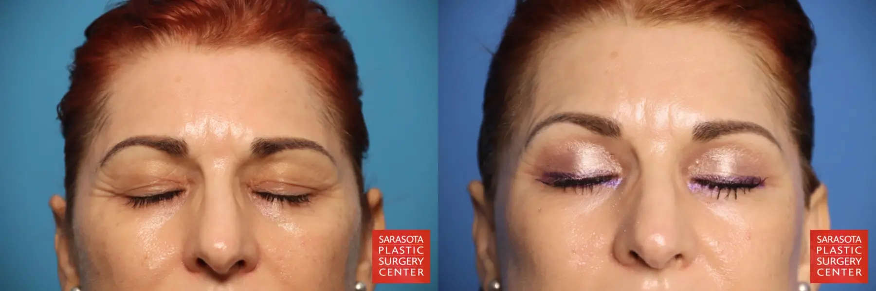 Brow Lift: Patient 3 - Before and After 3