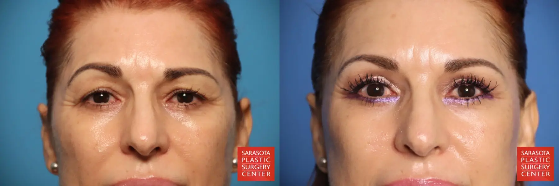 Brow Lift: Patient 3 - Before and After  