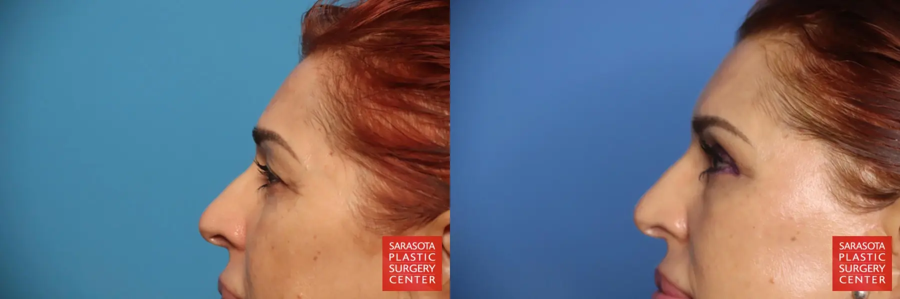 Brow Lift: Patient 3 - Before and After 5