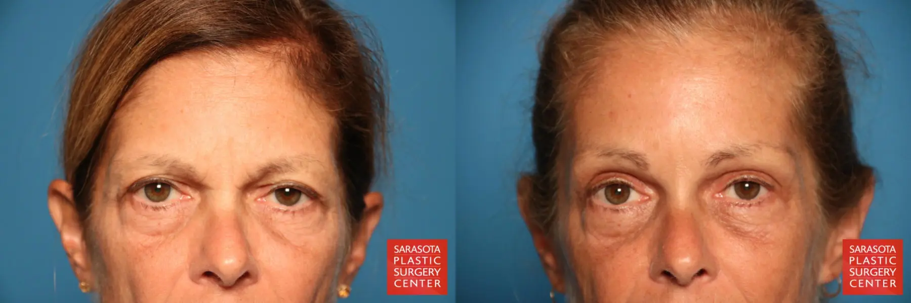Brow Lift: Patient 2 - Before and After 1