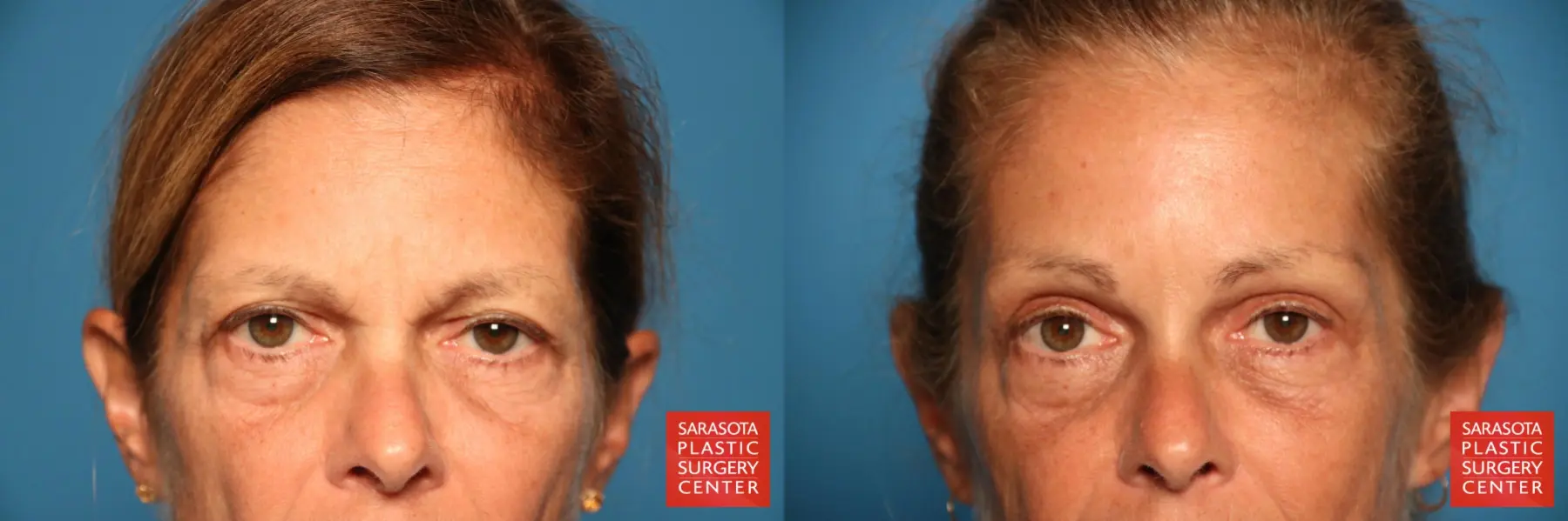 Brow Lift: Patient 2 - Before and After  