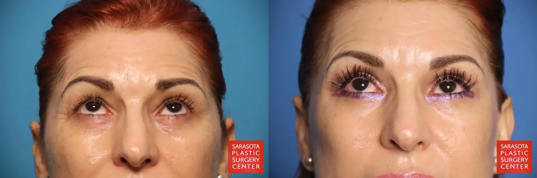 Brow Lift: Patient 3 - Before and After 2