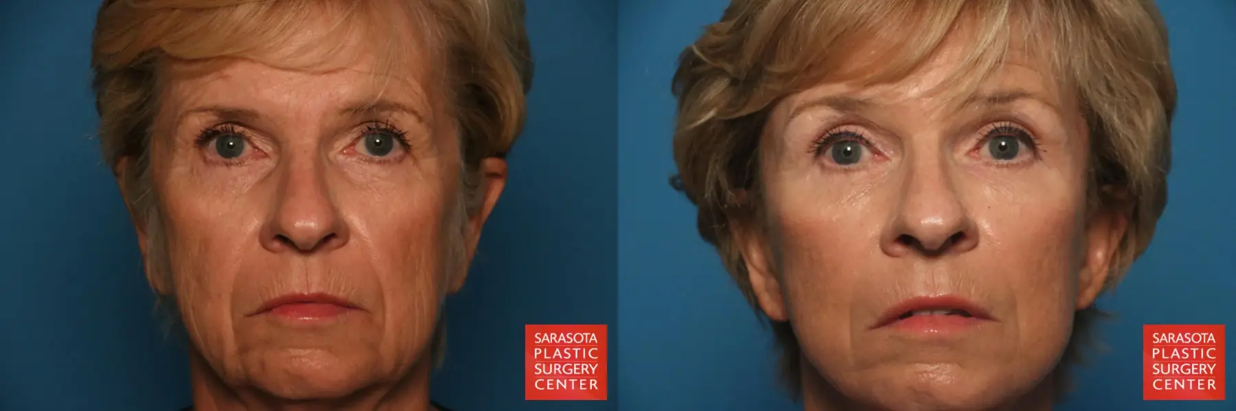 Brow Lift: Patient 5 - Before and After  