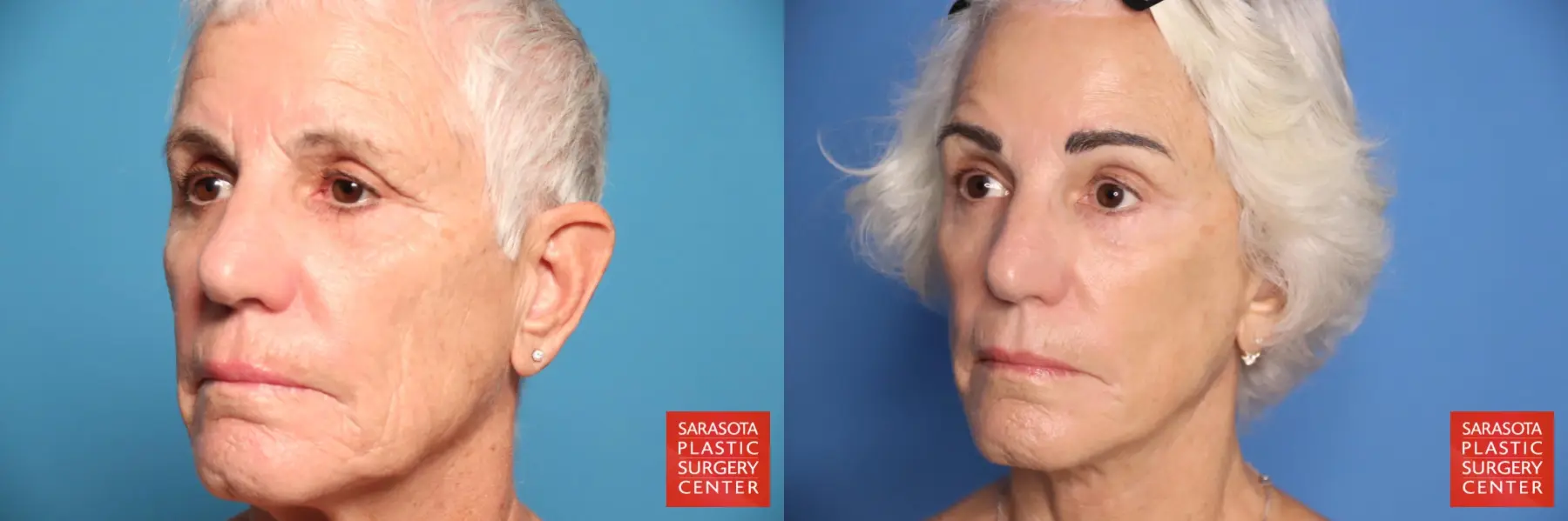 Brow Lift: Patient 4 - Before and After 2