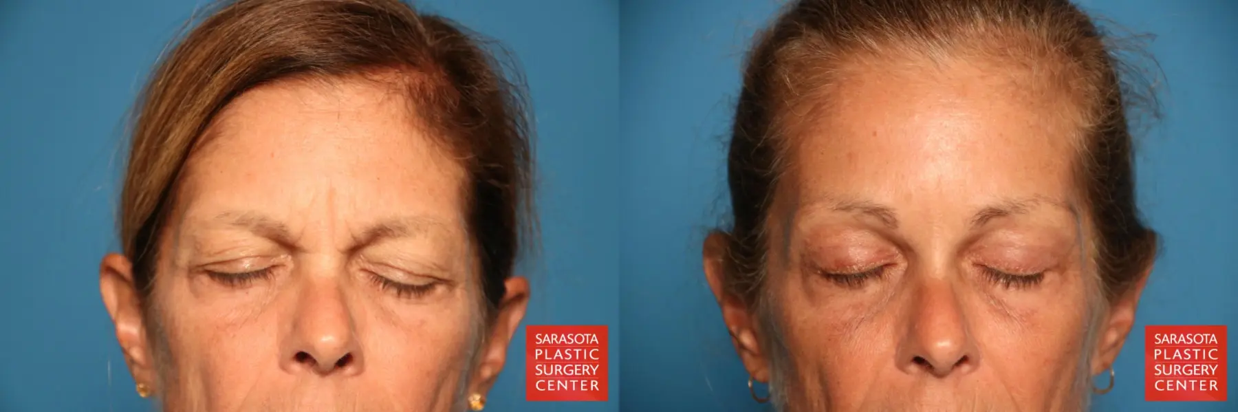 Brow Lift: Patient 2 - Before and After 4