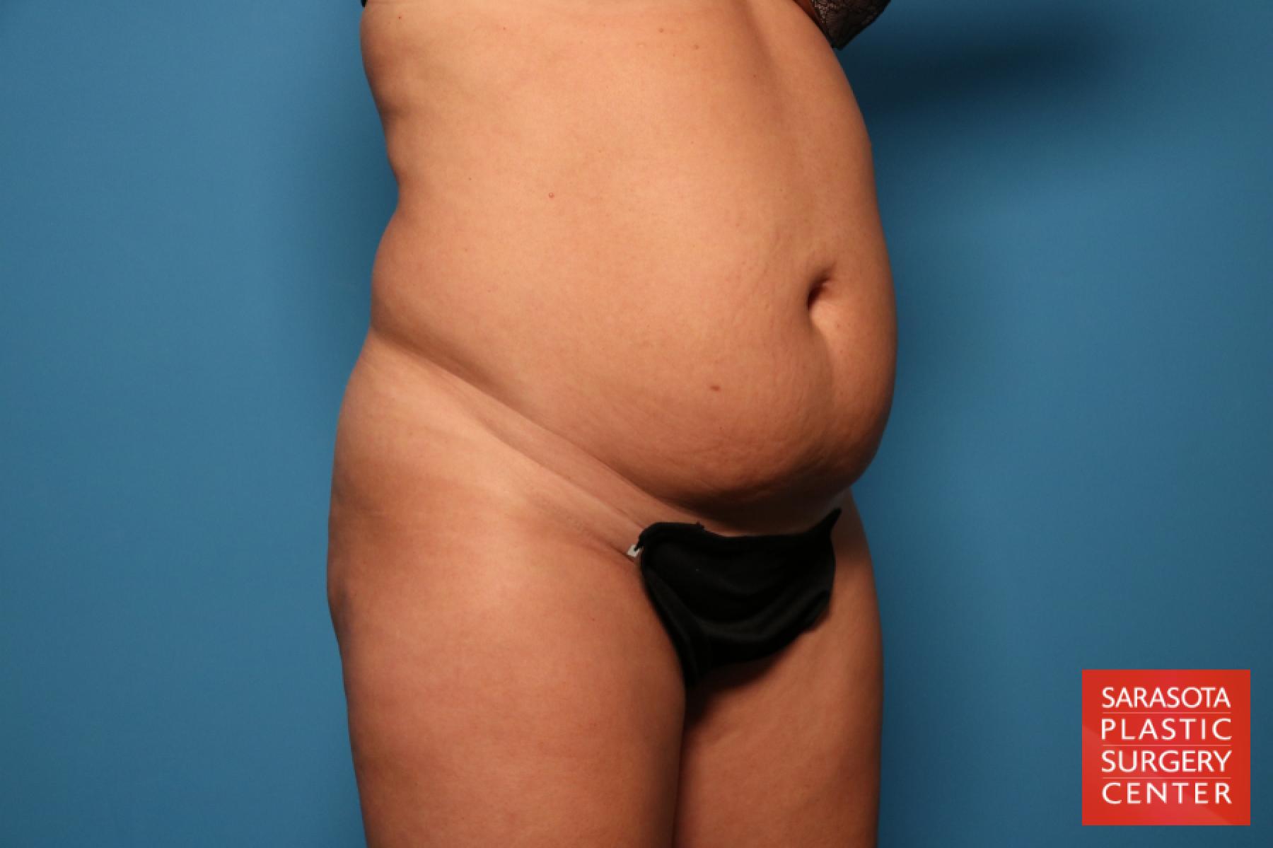Tummy Tuck: Patient 24 - Before 2