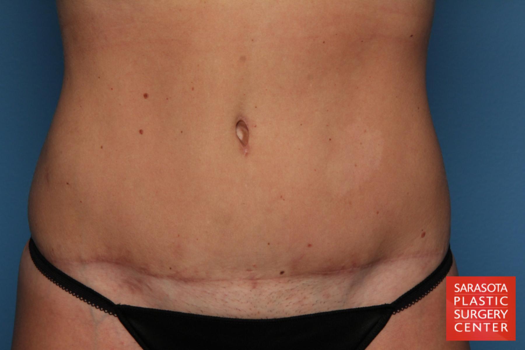 Tummy Tuck: Patient 8 - After  