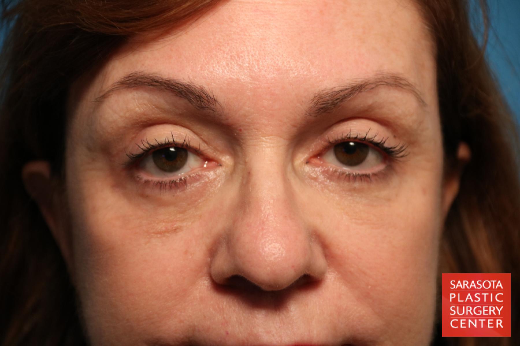 Eyelid Lift: Patient 31 - After 1