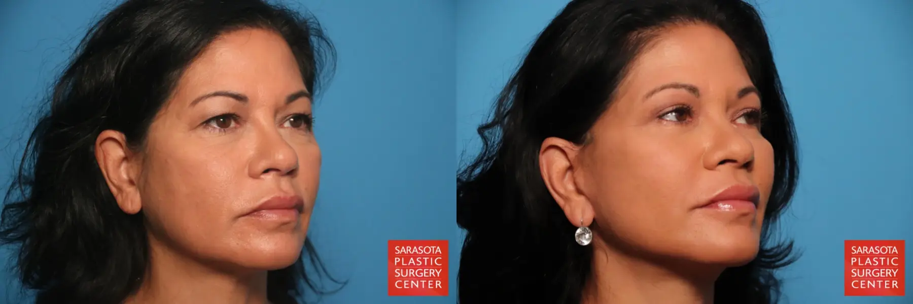 Cheek Lift: Patient 12 - Before and After 2