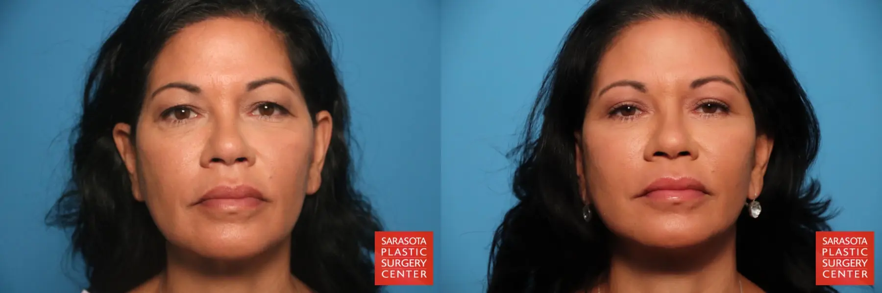 Cheek Lift: Patient 13 - Before and After  