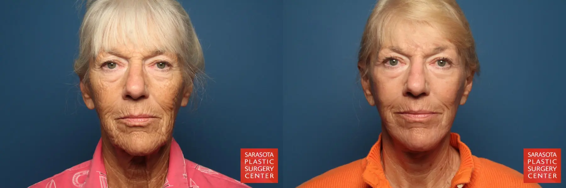 Cheek Lift: Patient 4 - Before and After  