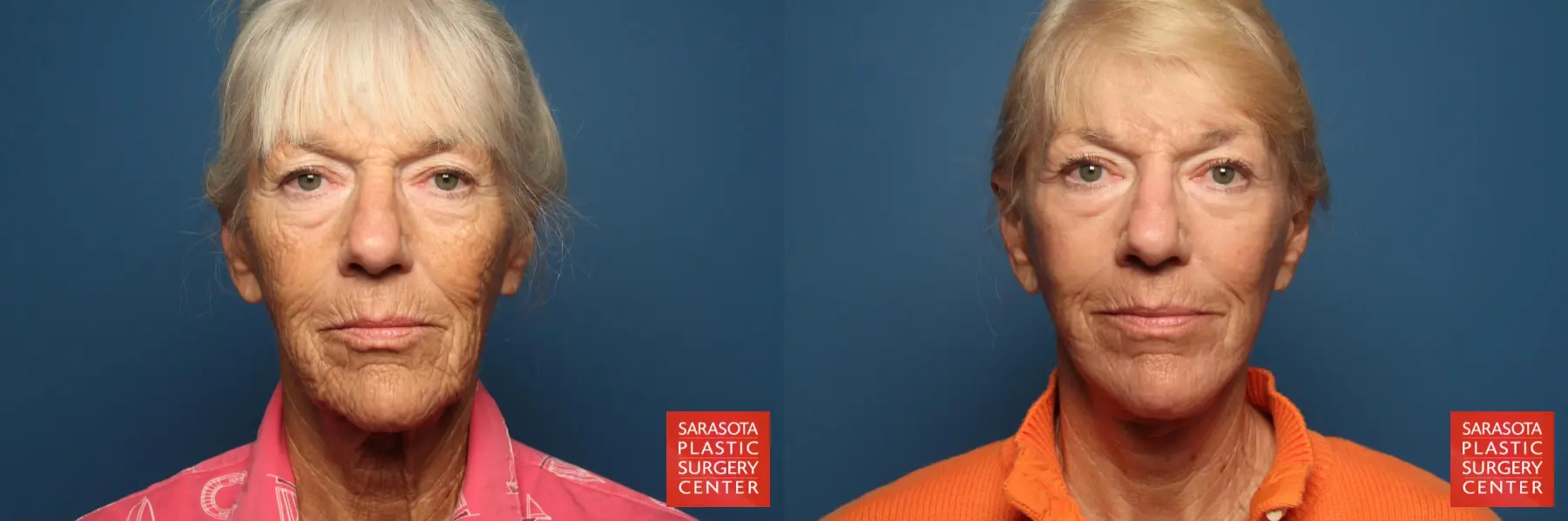 Cheek Lift: Patient 5 - Before and After  