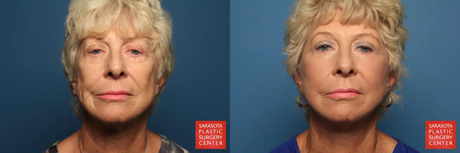 Cheek Lift: Patient 7 - Before and After  