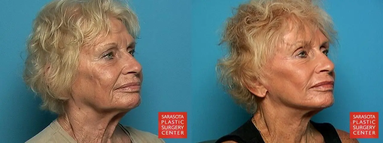 Cheek Lift: Patient 3 - Before and After 2