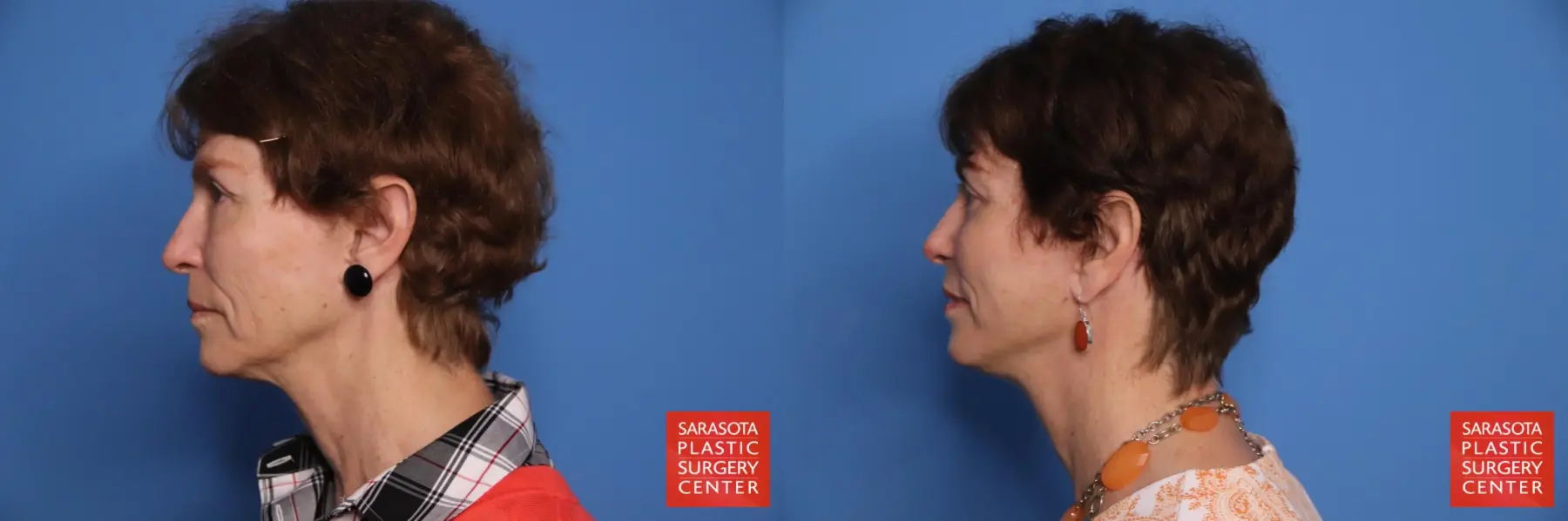 Cheek Lift: Patient 14 - Before and After 3