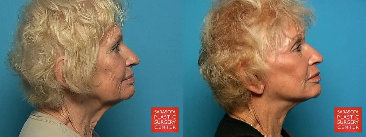 Cheek Lift: Patient 3 - Before and After 3