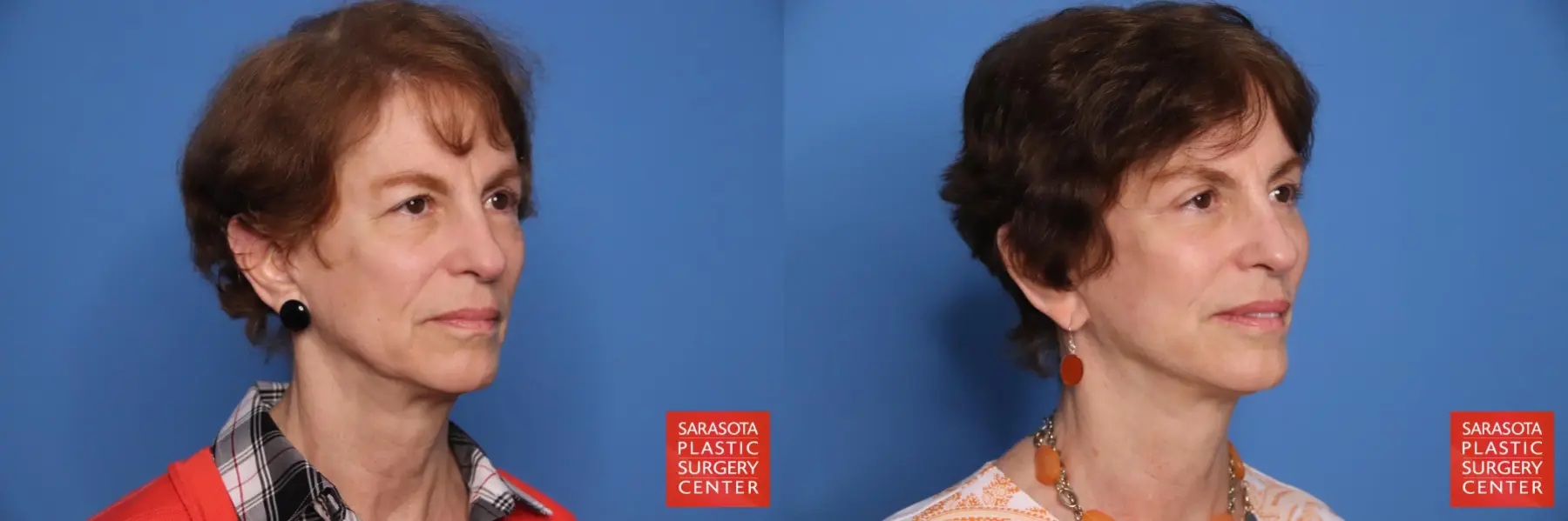 Cheek Lift: Patient 14 - Before and After 4