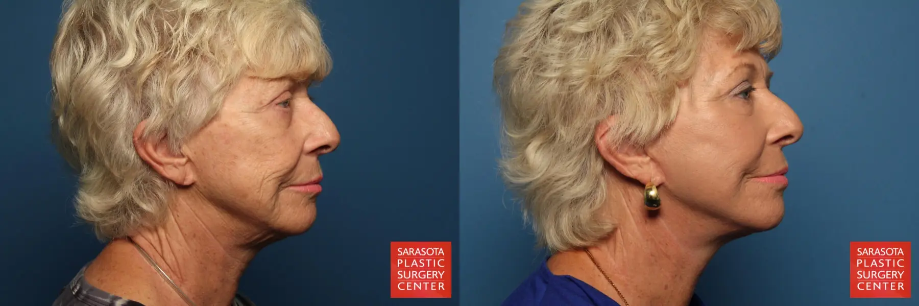Cheek Lift: Patient 7 - Before and After 5