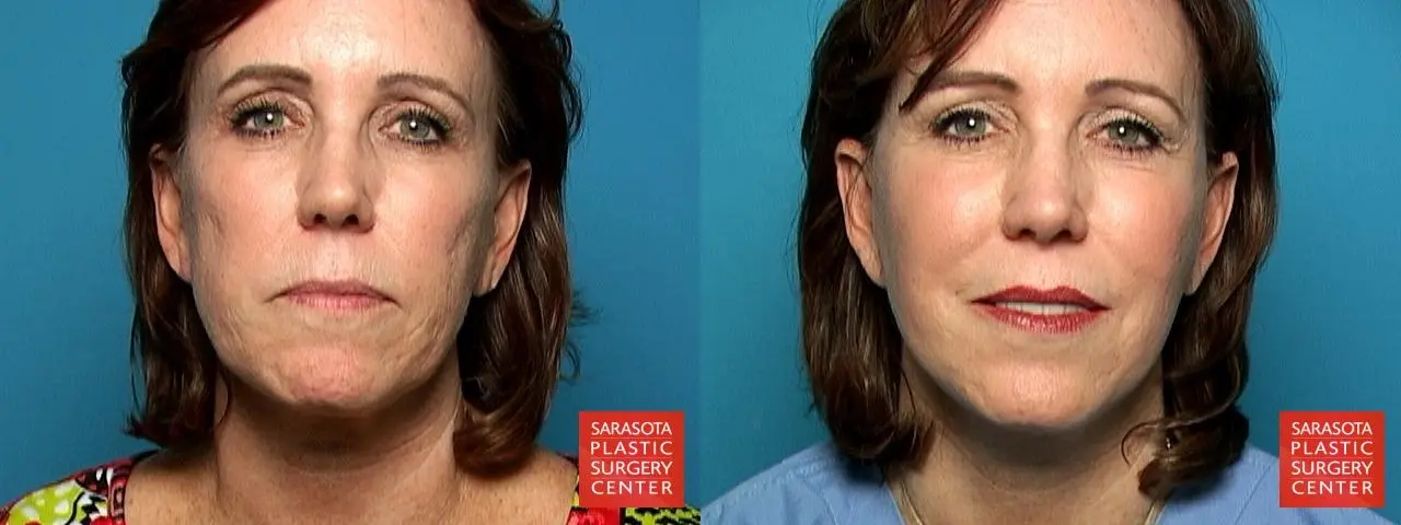 Cheek Lift: Patient 1 - Before and After  