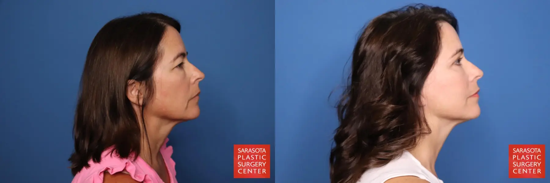 Cheek Lift: Patient 1 - Before and After 4