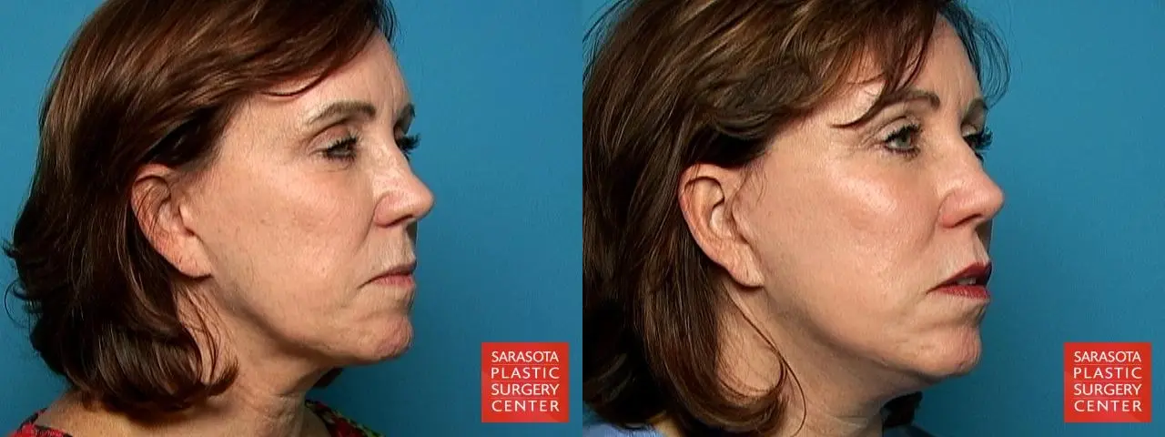 Cheek Lift: Patient 1 - Before and After 2