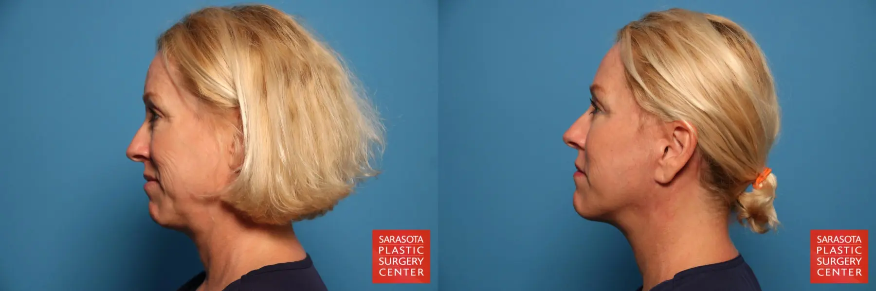 Cheek Lift: Patient 6 - Before and After 3