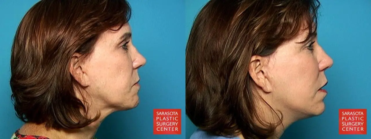 Cheek Lift: Patient 1 - Before and After 3