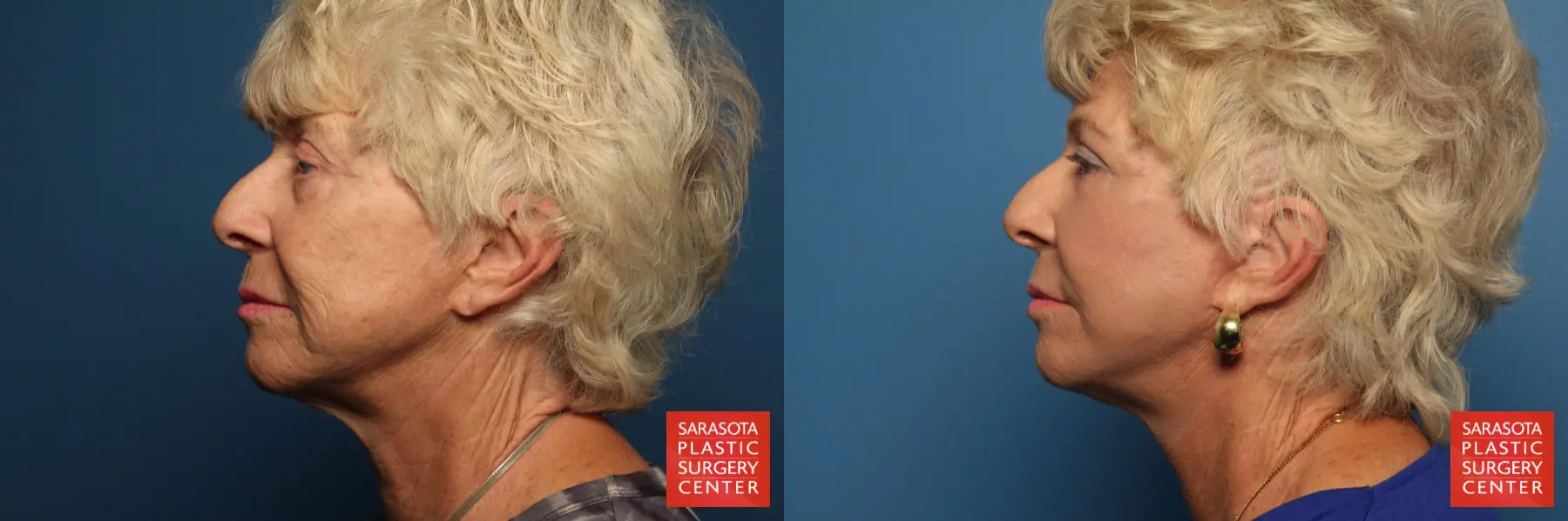 Cheek Lift: Patient 7 - Before and After 3