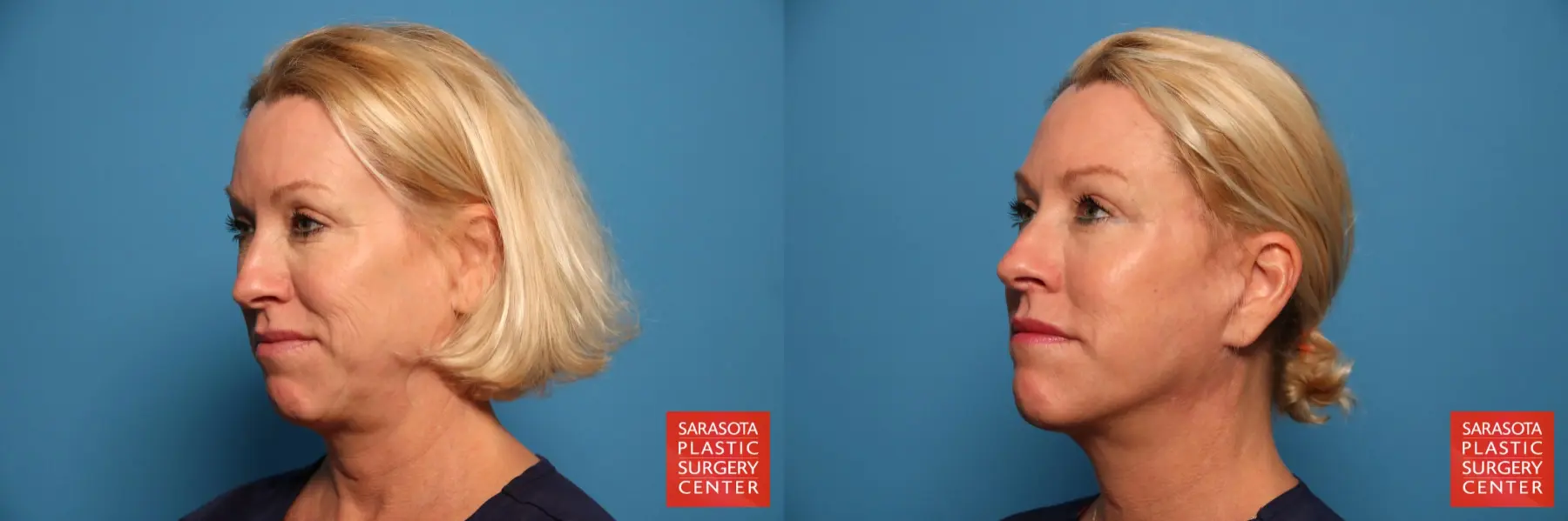 Cheek Lift: Patient 6 - Before and After 2
