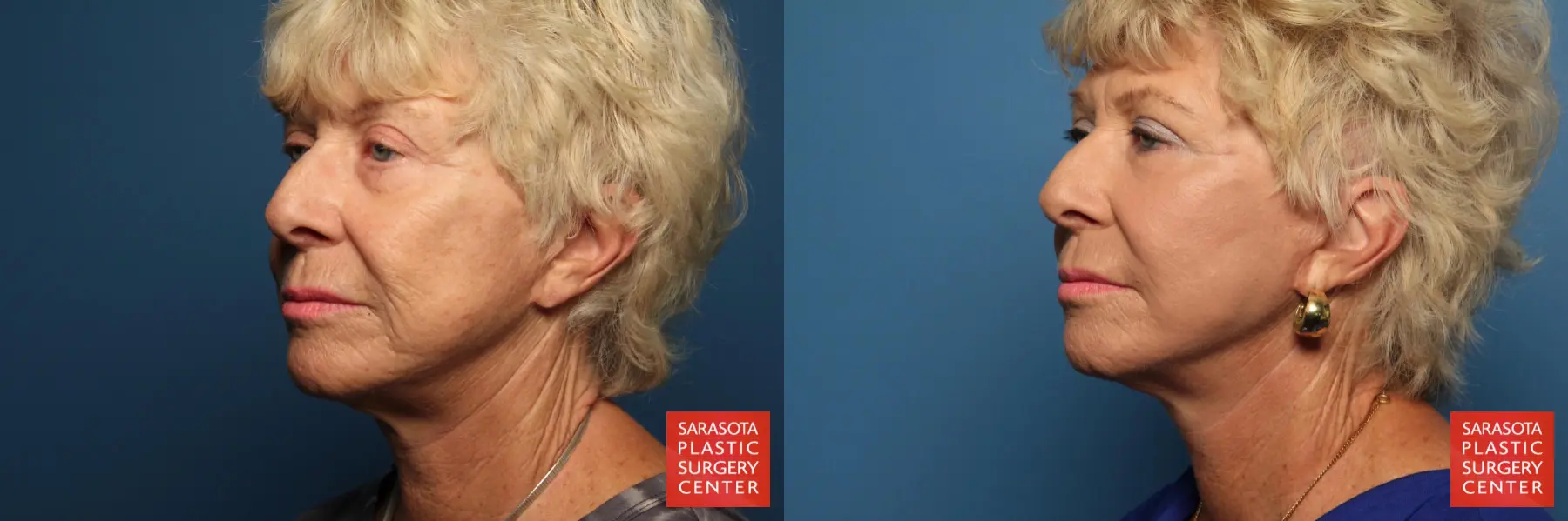 Cheek Lift: Patient 8 - Before and After 2
