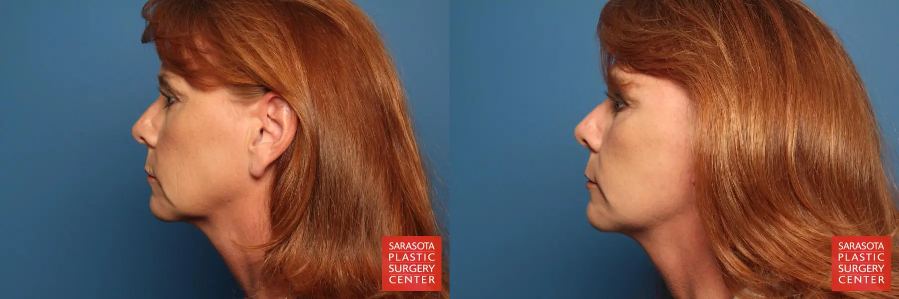 Cheek Lift: Patient 8 - Before and After 3