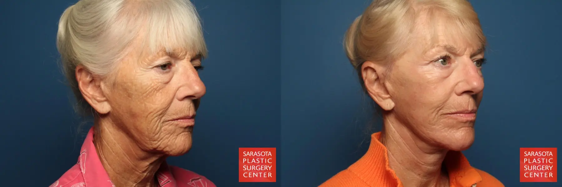 Cheek Lift: Patient 4 - Before and After 2