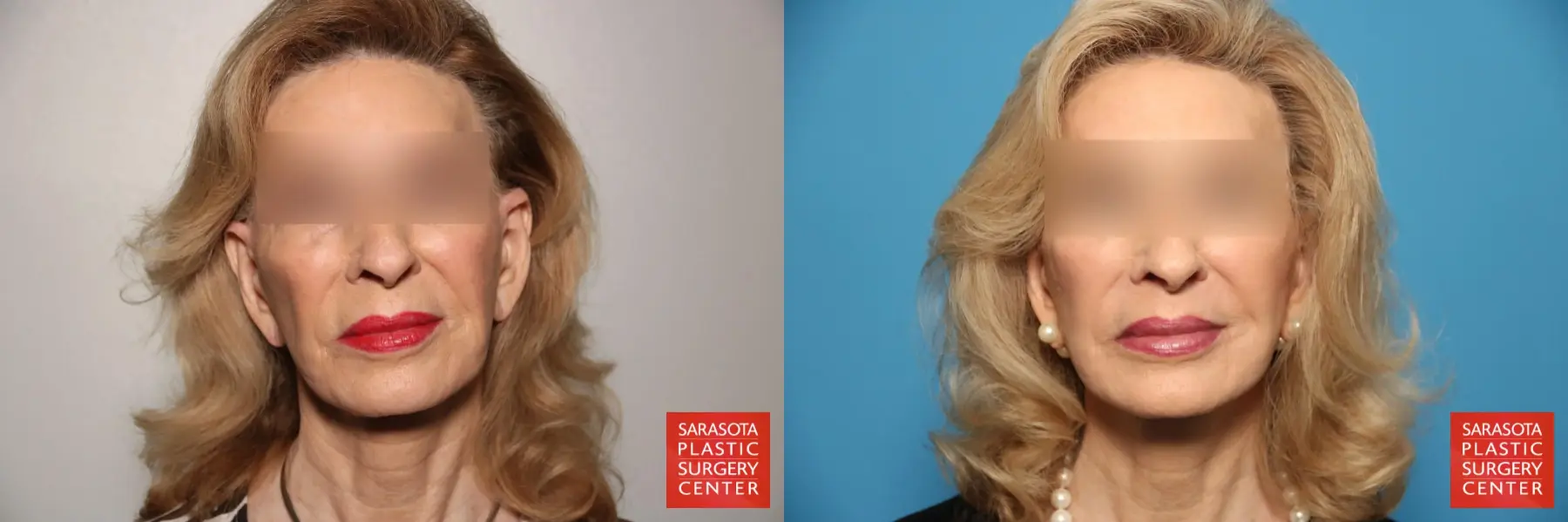 Cheek Lift: Patient 12 - Before and After  