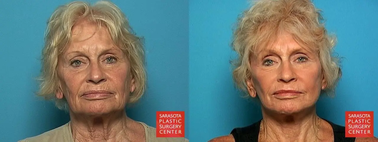 Cheek Lift: Patient 4 - Before and After  