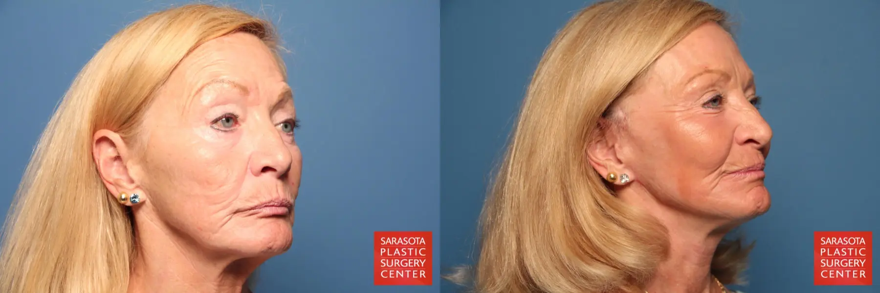 Cheek Lift: Patient 5 - Before and After 4