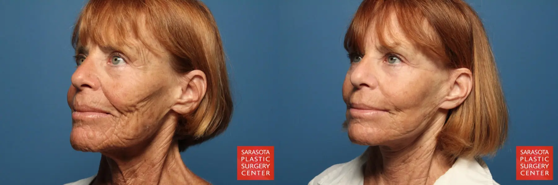 Cheek Lift: Patient 10 - Before and After 2