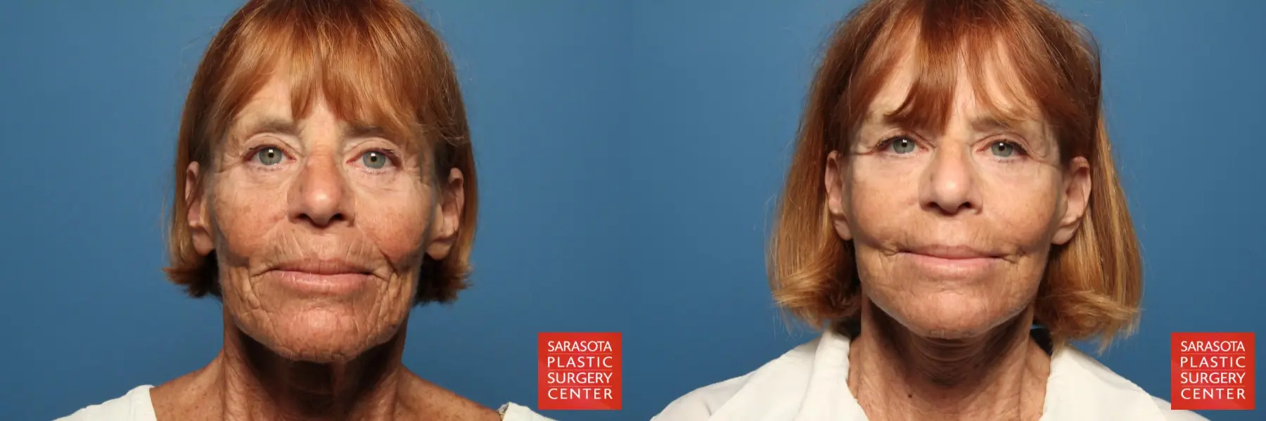 Cheek Lift: Patient 11 - Before and After  