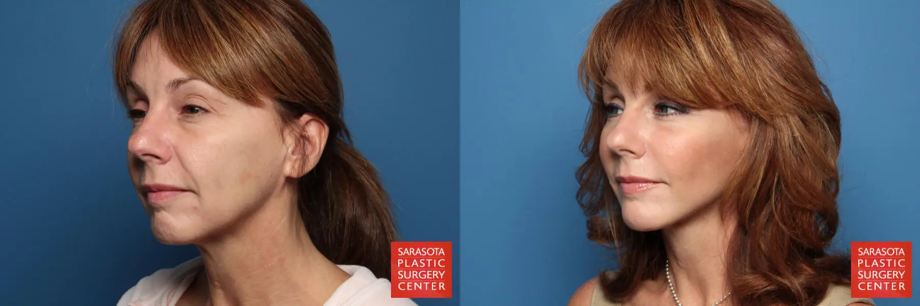 Cheek Lift: Patient 2 - Before and After 2
