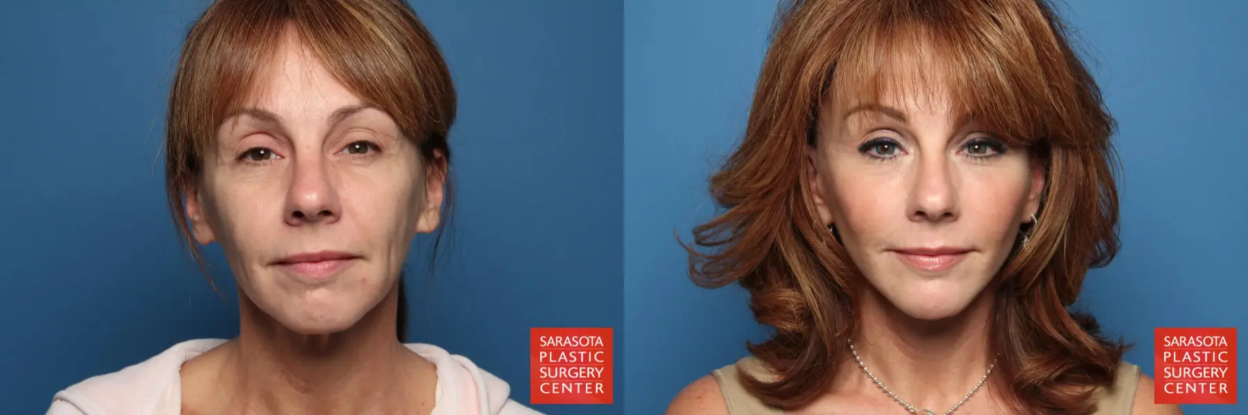 Cheek Lift: Patient 2 - Before and After  