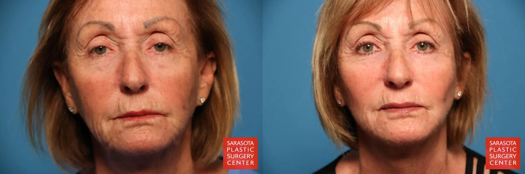 Cheek Lift: Patient 9 - Before and After  