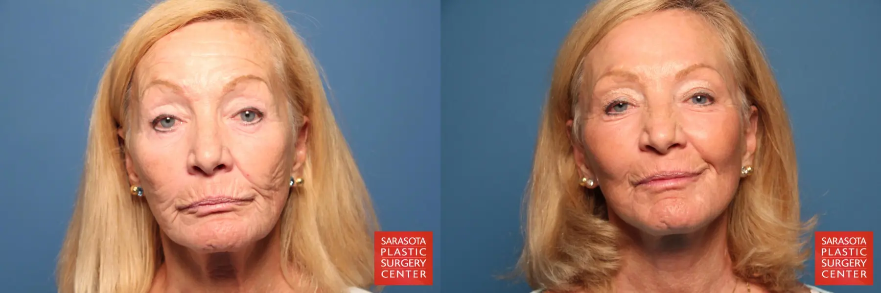 Cheek Lift: Patient 6 - Before and After  
